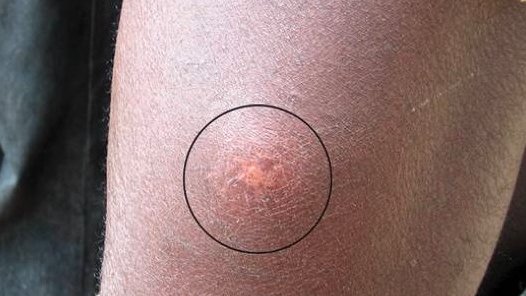 Buruli-Ulcer-Geschwür im Anfangsstadium. Buruli-Ulcer-Geschwür im Anfangsstadium. Im weiteren Verlauf kommt es zu ausgedehnten offenen Geschwüren.