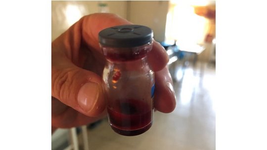 The picture shows a 20-minute Whole Blood Clotting Test (WBCT) in the emergency room of the Wa Municipal Hospital The picture shows a glass vial with blood. A hospital room can be seen in the background.