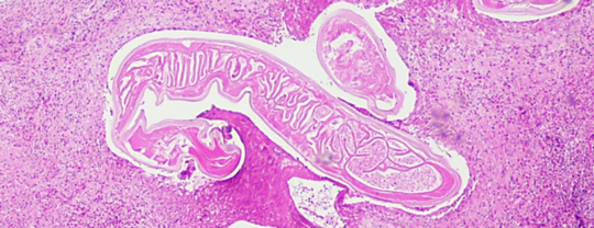 Dirofilaria repens in skin nodule from first autochthonous human infection in Germany. Dirofilaria repens in einem Hautknötchen aus der ersten autochthonen menschlichen Infektion in Deutschland: Ein Bild von rosa eingefärbtem Gewebe, in dessen Mitte sich eine deutlich andere Struktur wurmartig absetzt.