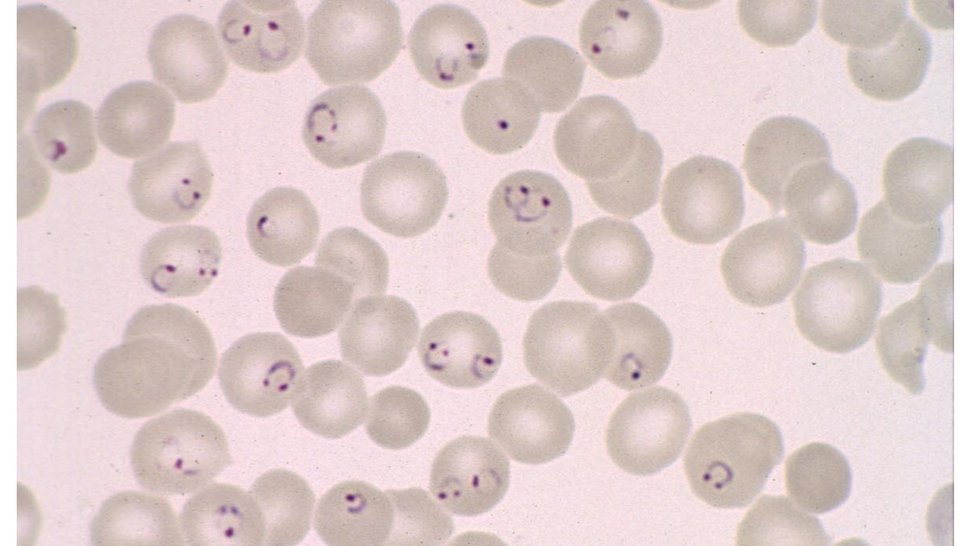 Blutausstrich mit Malaria-Parasiten unter dem Mikroskop Auf der mikroskopischen Aufnahme sind rote Blotkörperchen zu sehen, von denen ein paar mit dem Malariaparasiten befallen sind.