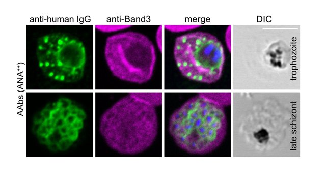 Fluoreszenzaufnahme des Malariaparasiten in roter Blutzelle Fluoreszenzaufnahme zeigt den Malariaparasiten in einem vielkernigen Entwicklungsstadium, wie er rote Blutzellen befallen hat.