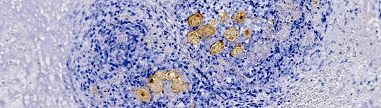 Immunohistological staining of amoebae of the species Entamoeba histolytica (brown) in the centre of a mouse liver abscess. Immunohistological staining shows blue-stained mouse liver cells, liver abscess stained brown, liver abscess caused by amoebae of the genus Entamoeba histolytica