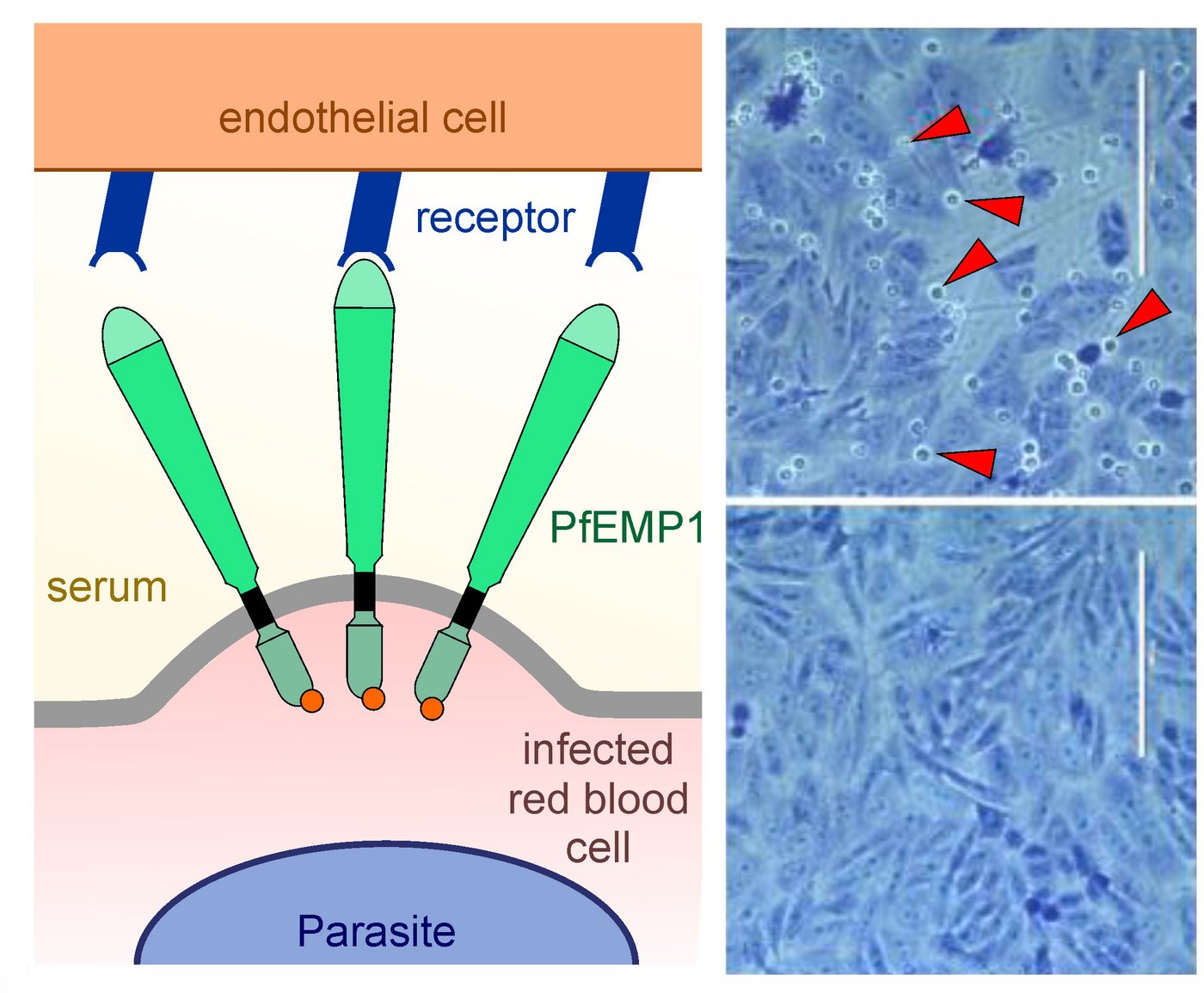 Links: Schematische Darstellung der Bindung eines mit einem Malariaparasiten infizierten roten Blutkörperchens an die Gefäßwand. Rechts: Zwei lichtmkroskopische Aufnahmen von Endothelzellen und roten Blutkörperchen.