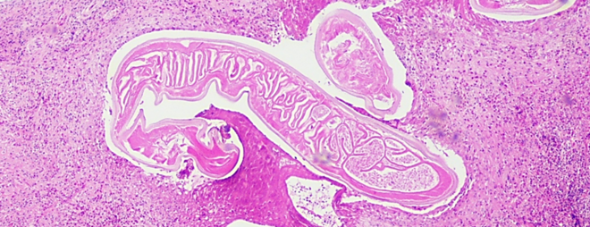 Dirofilaria repens in einem Hautknötchen aus der ersten autochthonen menschlichen Infektion in Deutschland: Ein Bild von rosa eingefärbtem Gewebe, in dessen Mitte sich eine deutlich andere Struktur wurmartig absetzt.